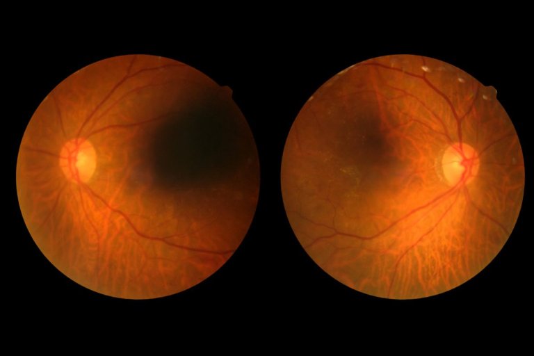 Maculopatia: scopri cos'è e come si può guarire